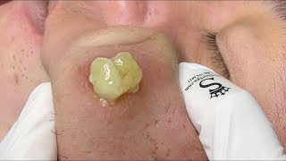 cystic acne blackhead whitehead removal  Relaxing Spa Acne Treatment [upl. by Cordeelia]