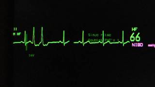 sinus rhythm with ventricular extrasystoles on an ECG monitor [upl. by Harlen]