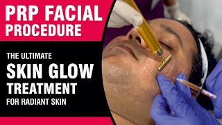 PRP Facial Procedure Video The Ultimate Skin Glow Treatment for Radiant Skin  Sakhiya Skin Clinic [upl. by Iatnwahs]