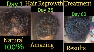 Amazing result hair regrowth new natural treatment [upl. by Laszlo762]