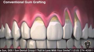 No Cutting Gum Graft with Pinhole Surgical Procedure [upl. by Dlorrej]