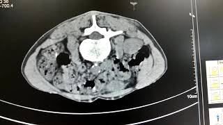 CT GUIDED BIOPSY OF MASS IN PARARENAL SPACE [upl. by Jannery]