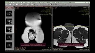 Non seminoma testicular tumor [upl. by Aicilev]