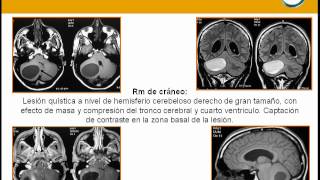 NeurorgsnetTumor quístico en cerebelo [upl. by Nawek]