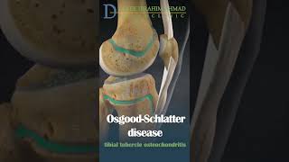 what is osgood schlatter disease [upl. by Ellehcir24]