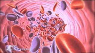 Eisenmenger Syndrome Medical Animation [upl. by Wengert]