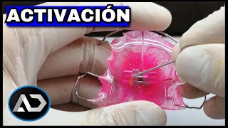 Como ACTIVAR Un Expansor de PALADAR Ortodoncia [upl. by Nealson]