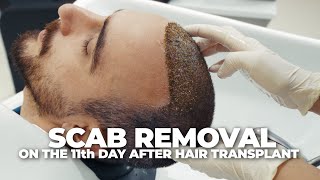 StepbyStep Scab Removal on the 11th Day After Hair Transplant [upl. by Charleton]