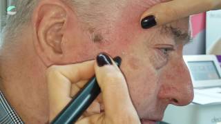 Queratosis Actínica con Laser de Plasma  Plasmalaser SCORPION [upl. by Nojid]