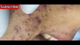 acne blackheads whiteheads removal  deep hard to get blackheads youtube [upl. by Einnij]