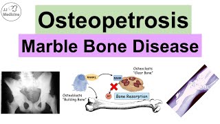 Osteopetrosis Marble Bone Disease  Causes Symptoms Diagnosis Treatment [upl. by Etnaed]