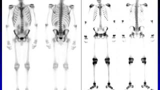 Essentials of Bone Scan  HD Basic Radiology [upl. by Akemihs]