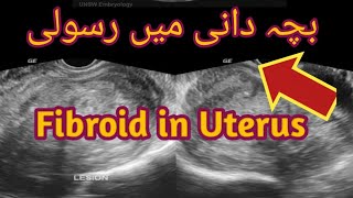 Fibroid UterusSubserosal fibroidUltrasound course [upl. by Phene639]