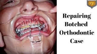 Repair of a Botched Orthodontic Case using reverse headgear upper lip bumper and opening space [upl. by Yerahcaz116]