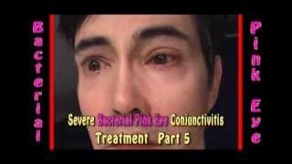 Severe Bacterial Pink Eye Conjunctivitis treatment part 5 [upl. by Aronas]