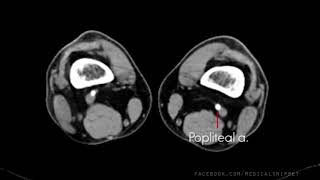 Lower Limb arterial anatomy  CT scan [upl. by Daniella]