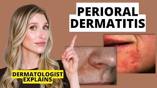 Dermatologist Explains Perioral Dermatitis What it Looks Like Causes amp Treatments  Dr Sam Ellis [upl. by Ynaitirb]