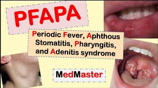 PFAPA Syndrome Periodic fever Aphtous stomatitis Pharyngitis Adenitis [upl. by Inar]