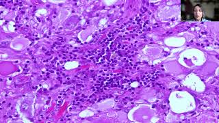 Tip39Ganglioglioma [upl. by Carlson]