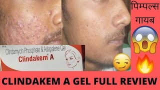 Clindakem A gel Full Review Effect abd Side Effect Best in Acne पिम्पल्स गायब होंगे इसको लो 💁💃😱💁🔥😻🔥 [upl. by Acirre]