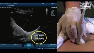 Hot Tip  Measuring Bladder Volume with Ultrasound [upl. by Coulter613]