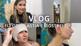 ANTES E DEPOIS DA MINHA CIRUGIA DE OTOPLASTIA  MOSTREI TUDO [upl. by Anaiuq]