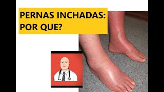 As 9 causas principais de pernas inchadas com sinais de alerta para ver o médico [upl. by Akciret]