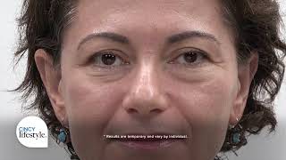 Plexaderm Helps Reduce UnderEye Bags and Wrinkles in Minutes  Cincy Lifestyle [upl. by Trocki]