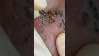 Elderly Blackhead Removal blackheads acne elderly pimplepopping whiteheads satisfying asmr [upl. by Annoval66]