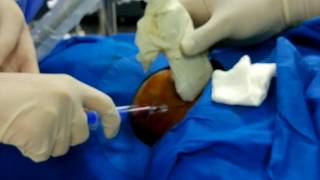 innominate vein cannulation [upl. by Eixam]