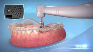 MIS Implants MGUIDE guided Implant placement procedure [upl. by Bracci279]