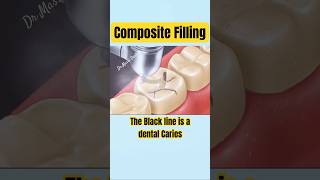 COMPOSITE FILLING on Molar tooth [upl. by Butch]