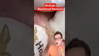 Crazy BLACKHEAD REMOVAL  So Many Blackheads shorts [upl. by Conlen]