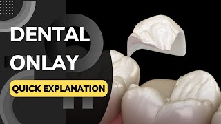 What is a Dental Onlay Quickly Explained in a Few Seconds [upl. by Leacock]