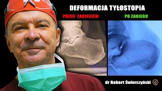 Deformacja tyłostopia  Pięta Haglunda  dr Robert Świerczyński Ortopedika [upl. by Ioab]