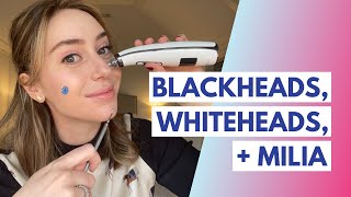 Blackheads vs Whiteheads vs Milia What is the Difference  How to Treat  Dr Shereene Idriss [upl. by Awjan259]