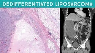 Dedifferentiated Liposarcoma huge retroperitoneal mass near kidney Oregon Case 12 [upl. by Etnoel]