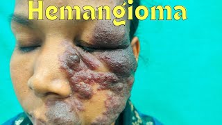 Vascular malformation Hemangioma  Planning of treatment Hemangioma treatment in Ranchi [upl. by Ula709]