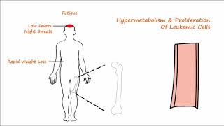 Acute Leukemia  Part 1 [upl. by Ludmilla]