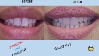 My result with aligners by Smile Direct [upl. by Alesram]