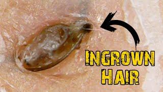 Ingrown Hair Removal x Satisfying Blackheads [upl. by Thomey]