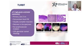 Urowebinar BCG unresponsive disease how this definition impact your treatment decision making [upl. by Kamerman]