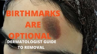 How to remove birthmarks [upl. by Legin]