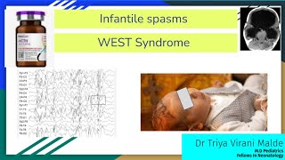 Infantile spasms  West syndrome with EEG  Neet PG  FMG  INI CET [upl. by Porush]