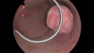 Polypectomy  Polyp Removal  Virtual Reality Simulation for Endoscopic Surgery [upl. by Ijies854]