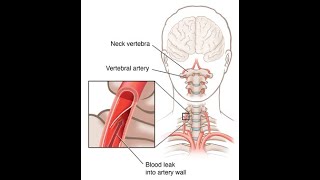 Applied or clinical anatomy of vertebral artery  Occlusion to branches of vertebral artery [upl. by Gibb]