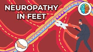 Dealing with Neuropathy in Feet Causes Symptoms and Treatments [upl. by Cordi]