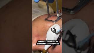 co2 laser treatment for acne scars  DrKasanas Clinic [upl. by Lussier68]