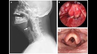 Epiglottitis [upl. by Vaclava191]