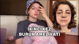 İKİNCİ BURUN AMELİYATI  VLOG burunameliyatı [upl. by Genie414]